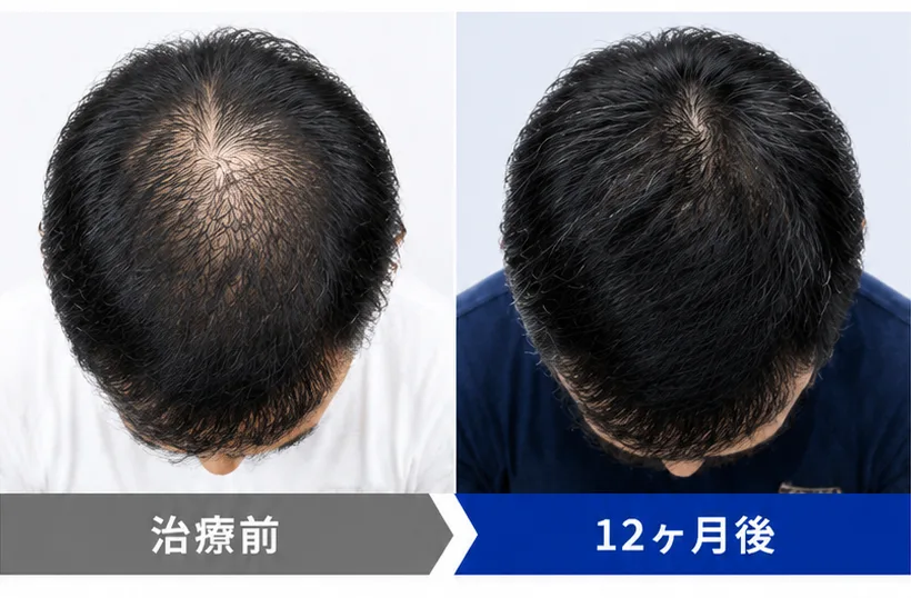40代男性 治療前 / 12ヶ月後